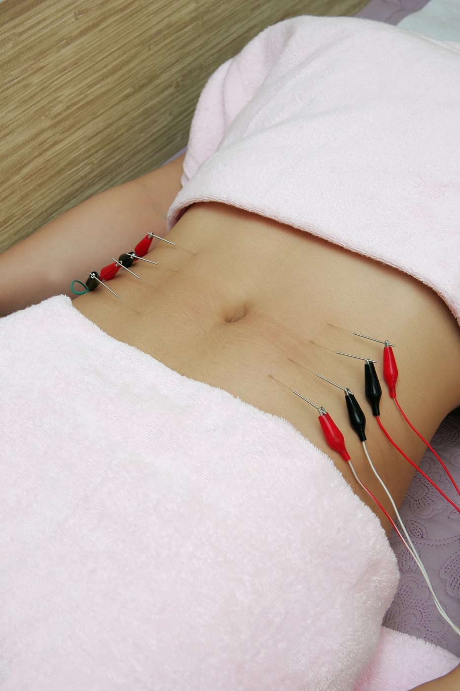 침에 전극을 연결해 자극을 주는 전침 치료